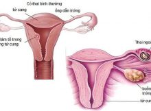 4 dấu hiệu thai ngoài tử cung sớm nhất phụ nữ cần biết 3