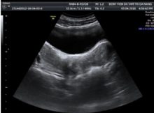 hình ảnh siêu âm bộ phận sinh dục bé gái
