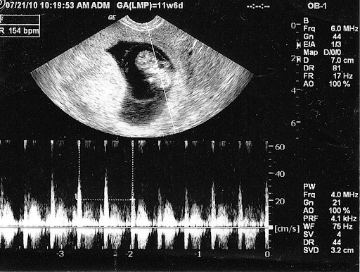 Giải đáp thắc mắc túi thai bao nhiêu mm thì có tim thai