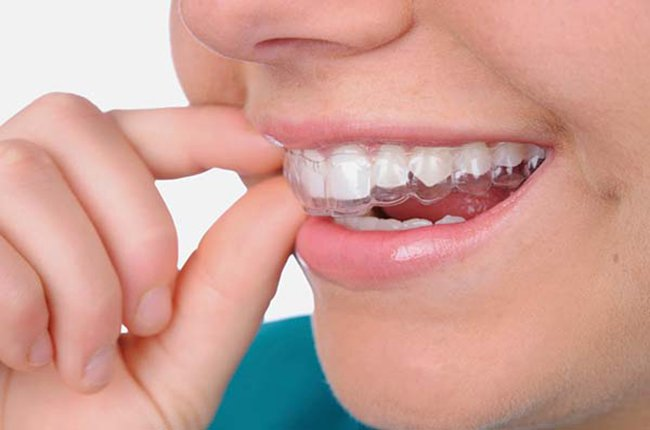 Niềng răng Invisalign giảm thiểu được cảm giác đau đớn